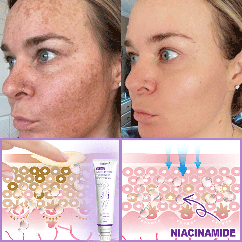 FDA Official ✅ : Vitalisys® PDRN Multi-Peptide Massaging Body Roller Cream ✨ - Anti-aging, Hydrating, Skin Firming & Lifting, Skin Repair, Even Tone, Acne and Dark Spot Treatment, Wart and Mole Removal, and Psoriasis Relief 💕