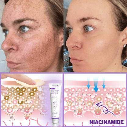 FDA Official ✅ : Vitalisys® PDRN Multi-Peptide Massaging Body Roller Cream ✨ - Anti-aging, Hydrating, Skin Firming & Lifting, Skin Repair, Even Tone, Acne and Dark Spot Treatment, Wart and Mole Removal, and Psoriasis Relief 💕