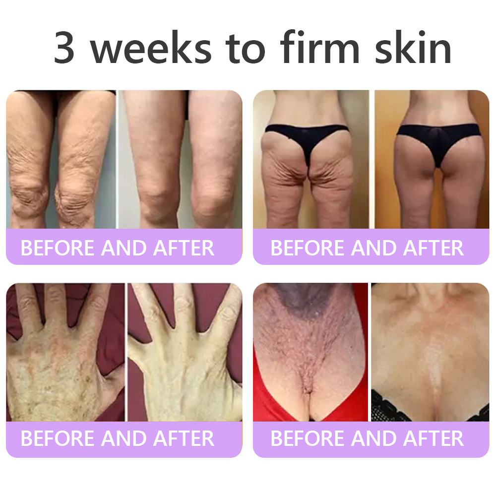 FDA Official ✅ : Vitalisys® PDRN Multi-Peptide Massaging Body Roller Cream ✨ - Anti-aging, Hydrating, Skin Firming & Lifting, Skin Repair, Even Tone, Acne and Dark Spot Treatment, Wart and Mole Removal, and Psoriasis Relief 💕