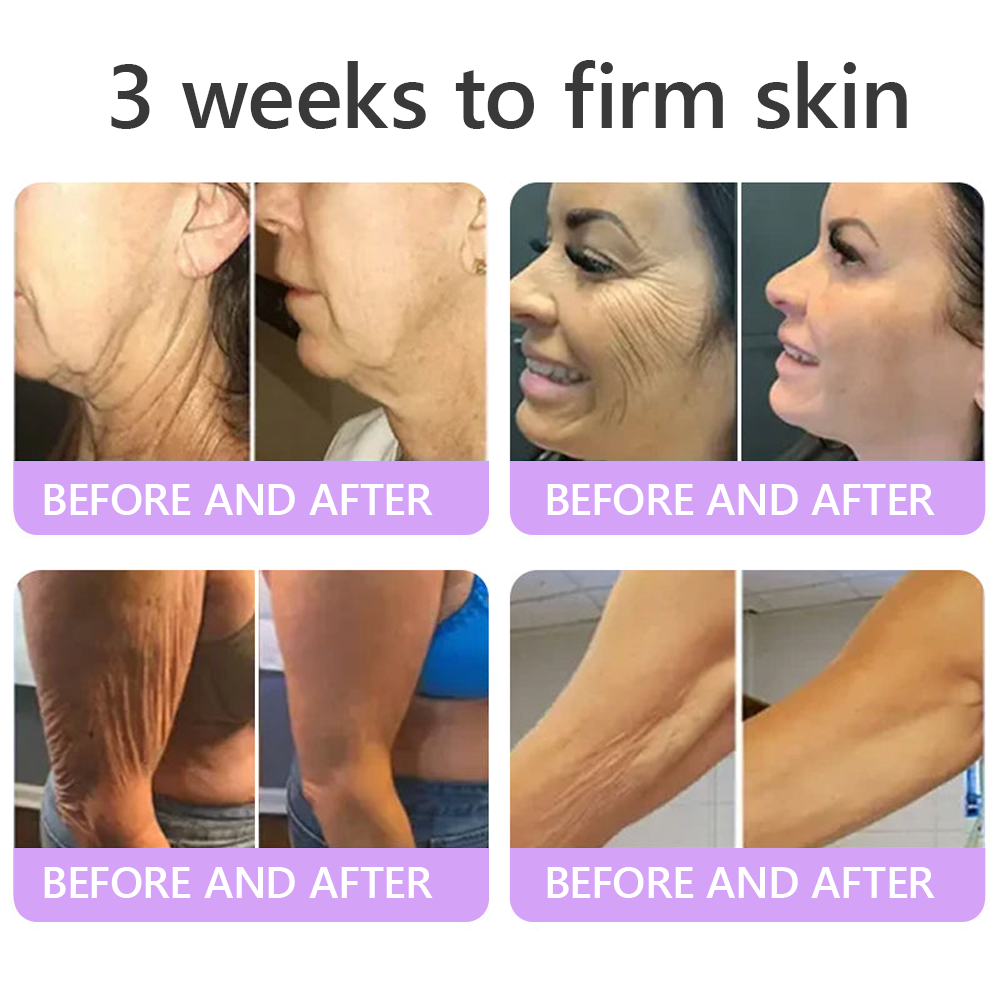 FDA Official ✅ : Vitalisys® PDRN Multi-Peptide Massaging Body Roller Cream ✨ - Anti-aging, Hydrating, Skin Firming & Lifting, Skin Repair, Even Tone, Acne and Dark Spot Treatment, Wart and Mole Removal, and Psoriasis Relief 💕